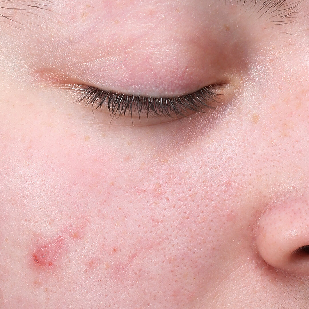 Symphonic M.D. Retinol Before